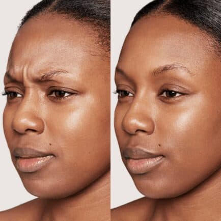 Botox for Her — Soften Forehead Lines, Frown Lines & Crow's Feet